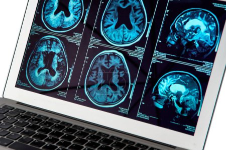 Photo for Magnetic resonance imaging of the human brain in close-up on a computer screen, for neurological medical diagnosis of human brain diseases. - Royalty Free Image