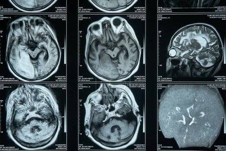 Imágenes por resonancia magnética, diagnóstico y tratamiento de enfermedades cerebrales.