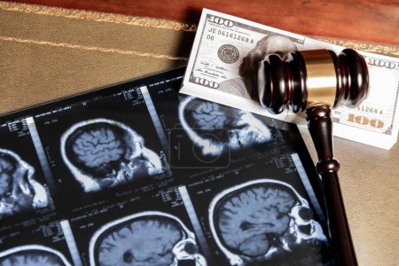 A concept image depicting MRI brain scans overlaid with a judges gavel and cash, implying legal and financial aspects of healthcare