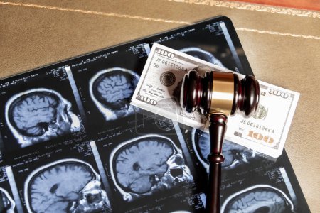 Un mélange de concepts juridiques et médicaux comprenant des images d'IRM cérébrale, un marteau et une monnaie américaine