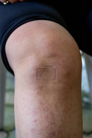 Foto de Reumatismo inflamatorio. Piernas hinchadas de mujeres con artritis reumatoide. - Imagen libre de derechos