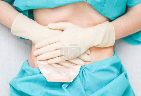A young caucasian patient lies on a bed in disposable pajamas with a clostoma bag which he presses with his hands in sterile gloves, flat lay close-up with depth of field, step 7. Medical concept, abdominal diseases, surgery, step by step instruction