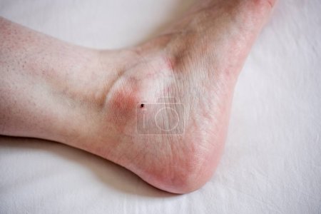 Foto de Una pequeña garrapata incrustada en la piel de una pierna de mujer en un día de verano, vista de cerca desde arriba. - Imagen libre de derechos