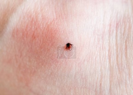 Eine kleine Zecke eingebettet in die Haut eines kaukasischen Mannes am Bein an einem Sommertag, Nahaufnahme von oben. Zecke eingebettet in die Haut einer Person.