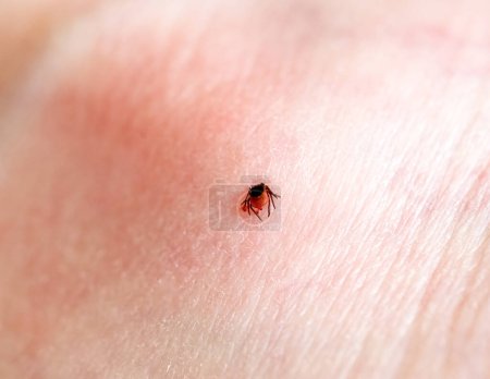 A One small tick embedded in the skin of a Caucasian man on the leg on a summer day, close-up view from above.tick embedded in a person skin.