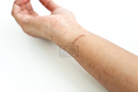 Téléchargez les photos : Cicatrices de sang sur la peau d'un couteau. - en image libre de droit