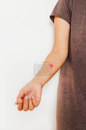 Foto de Herpes zóster, herpes zóster o herpes zóster en mujeres brazo aislado - Imagen libre de derechos
