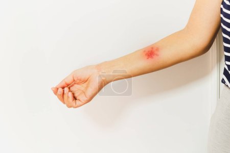 Photo for Shingles, Zoster or Herpes Zoster symptoms on womans arm isolated - Royalty Free Image