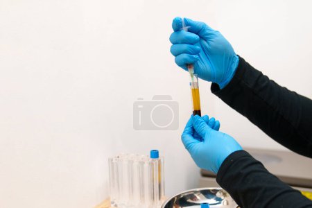A nurse extracts plasma from a blood sample for PRP therapy.