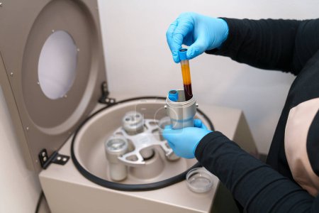 Centrifuge loading with blood sample for PRP treatment.