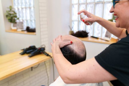 Photo for Specialist sprays treatment on scalp for prosthesis preparation - Royalty Free Image