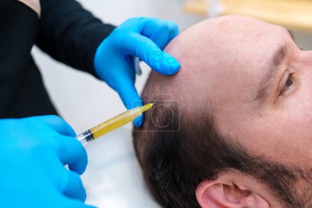Téléchargez les photos : Un clinicien administre une injection de PRP au cuir chevelu du patient. - en image libre de droit