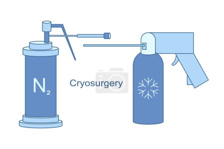 Téléchargez les illustrations : Instruments cryo pour l'illustration de lignes vectorielles de cryochirurgie. Refroidissement à l'azote liquide pour traitement cryogénique. Traitement par glace pour les lésions bénignes et malignes. - en licence libre de droit