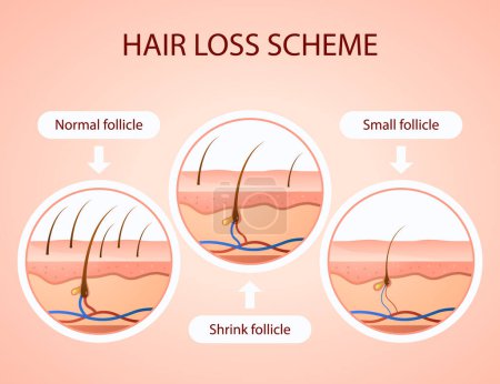 Gradient hair loss scheme Vector illustration