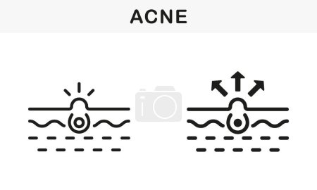 Illustration for Skin Acne, Blackhead, Comedo Line and Silhouette Black Icon Set. Pimple and Inflammation Sebum Pictogram. Deep Dirty Pore, Skin Problem Symbol Collection. Isolated Vector Illustration. - Royalty Free Image