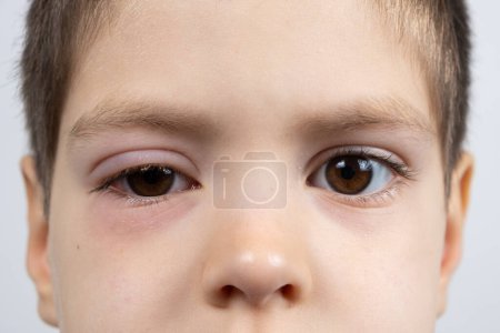 Photo for Eye of a 5-year-old child with conjunctivitis, inflammation of the conjunctiva, close-up. Pediatric ophthalmology - Royalty Free Image