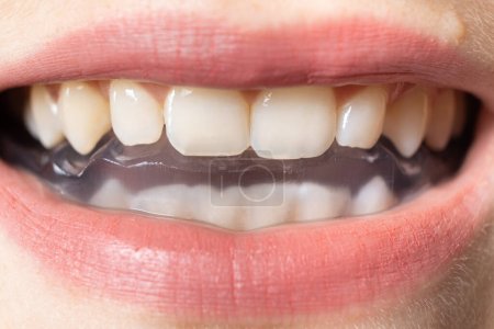 Zahnschutz, Schiene im Mund zur Behandlung von Kiefergelenkstörungen, Bruxismus, Malokklusion, um die Kiefermuskulatur zu entspannen