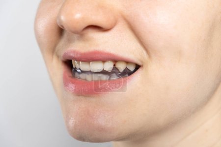 Photo for Dental mouthguard, splint in the mouth for the treatment of dysfunction of the temporomandibular joints, bruxism, malocclusion, to relax the muscles of the jaw - Royalty Free Image