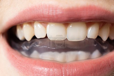 Protège-dents dentaires, attelle dans la bouche pour le traitement du dysfonctionnement des articulations temporomandibulaires, bruxisme, malocclusion, pour détendre les muscles de la mâchoire