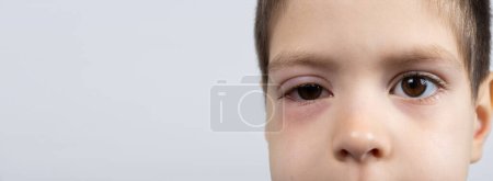 Auge eines 5-jährigen Kindes mit Bindehautentzündung, Bindehautentzündung, Nahaufnahme. Kinderaugenheilkunde