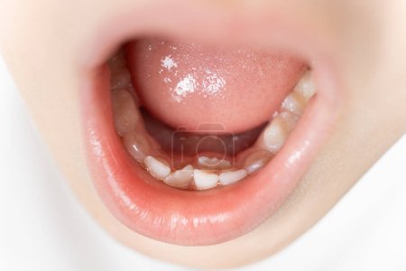 Krumm wachsende Zähne als Ersatz für Milchzähne bei Kindern. Die zweite Zahnreihe, der Zahn wächst, während der Schneidezahn noch nicht herausgefallen ist