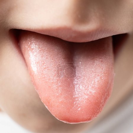 Foto de La lengua de un niño sano de seis años, papilas en la lengua. - Imagen libre de derechos