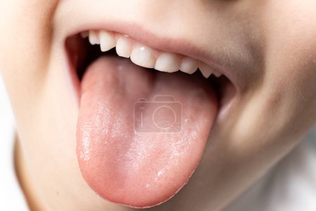 Téléchargez les photos : La langue d'un enfant de six ans en bonne santé, papilles sur la langue. - en image libre de droit