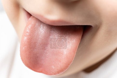 La langue d'un enfant de six ans en bonne santé, papilles sur la langue.