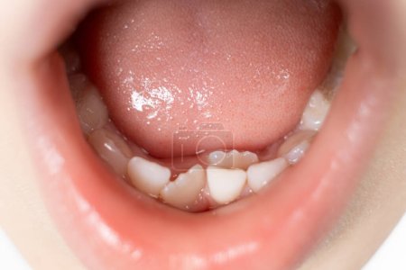 Téléchargez les photos : Crookedly dents de plus en plus pour remplacer les dents de lait chez un enfant. La deuxième rangée de dents, la dent pousse alors que l'incisive n'est pas encore tombée - en image libre de droit