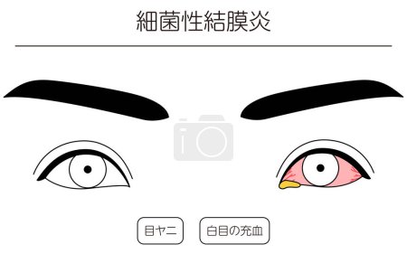 Illustration for Medical Clipart, Line Drawing Illustration of Eye Disease and Bacterial conjunctivitis, Vector Illustration - Royalty Free Image