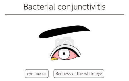 Illustration for Medical Clipart, Line Drawing Illustration of Eye Disease and Bacterial conjunctivitis, Vector Illustration - Royalty Free Image