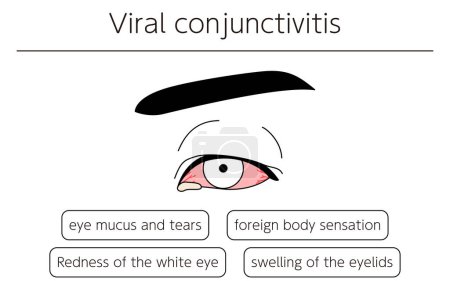 Illustration for Medical Clipart, Line Drawing Illustration of Eye Disease and Viral conjunctivitis, Vector Illustration - Royalty Free Image
