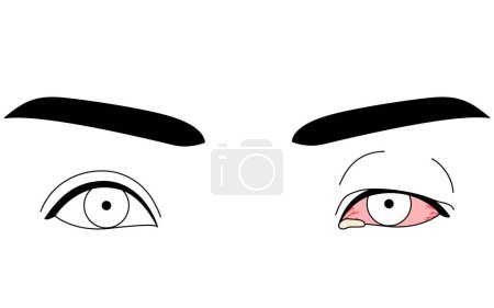 Illustration for Medical Clipart, Line Drawing Illustration of Eye Disease and Viral conjunctivitis, Vector Illustration - Royalty Free Image