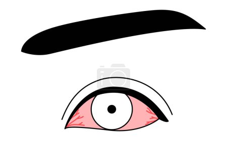 Illustration for Medical Clipart, Line Drawing Illustration of Eye Disease and Conjunctivitis, Vector Illustration - Royalty Free Image