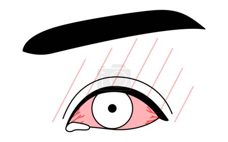 Illustration for Medical Clipart, Line Drawing Illustration of Eye Disease and Allergic conjunctivitis, Vector Illustration - Royalty Free Image