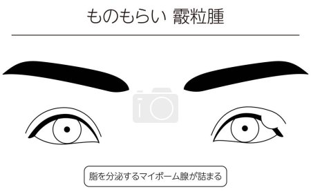 Illustration for Medical Clipart, Line Drawing Illustration of Eye Disease and Sty, chalazia - Translation: Sty, chalazia, Clogged meibomian glands that secrete oil - Royalty Free Image