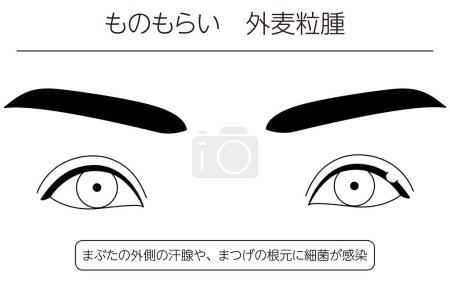 Illustration for Medical Clipart, Line Drawing Illustration of Eye Disease and Sty, external hordeolum - Translation: Sty, external hordeolum, Bacterial infection of the outer sweat glands of the eyelid or the base of the eyelashes - Royalty Free Image