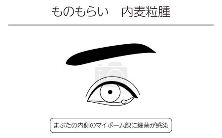 Illustration for Medical Clipart, Line Drawing Illustration of Eye Disease and Sty, hordeolum internum - Translation: Sty, hordeolum internum, Bacterial infection of the meibomian glands inside the eyelid - Royalty Free Image