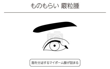 Illustration for Medical Clipart, Line Drawing Illustration of Eye Disease and Sty, chalazia - Translation: Sty, chalazia, Clogged meibomian glands that secrete oil - Royalty Free Image