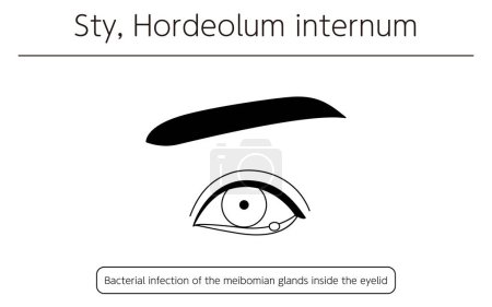 Illustration for Medical Clipart, Line Drawing Illustration of Eye Disease and Sty, hordeolum internum, Vector Illustration - Royalty Free Image