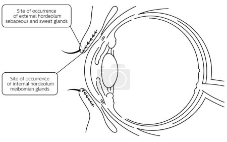Illustration for Medical illustration, Anatomical drawing of the site of origin of eye disease and mononucleosis, Vector Illustration - Royalty Free Image