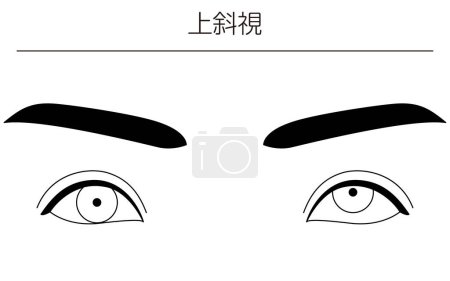 Illustration for Medical illustrations, diagrammatic line drawings of eye diseases, strabismus and hypertropia,  - Translation: hypertropia - Royalty Free Image
