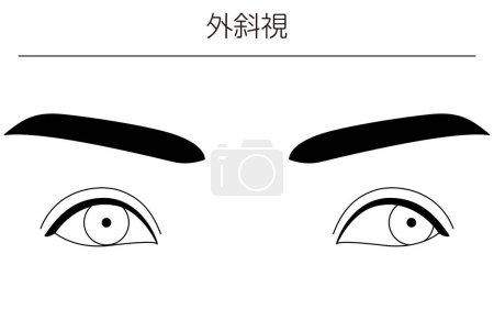 Illustration for Medical illustrations, diagrammatic line drawings of eye diseases, strabismus and exotropia,  - Translation: exotropia - Royalty Free Image