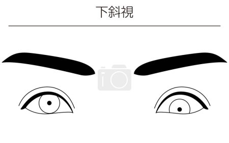 Illustration for Medical illustrations, diagrammatic line drawings of eye diseases, strabismus and hypotropia,  - Translation: hypotropia - Royalty Free Image