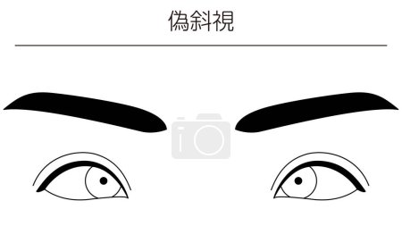 Illustration for Medical illustrations, diagrammatic line drawings of eye diseases, strabismus and pseudostrabismus,  - Translation: pseudostrabismus - Royalty Free Image