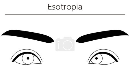 Illustration for Medical illustrations, diagrammatic line drawings of eye diseases, strabismus and esotropia, Vector Illustration - Royalty Free Image