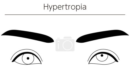 Illustration for Medical illustrations, diagrammatic line drawings of eye diseases, strabismus and hypertropia, Vector Illustration - Royalty Free Image