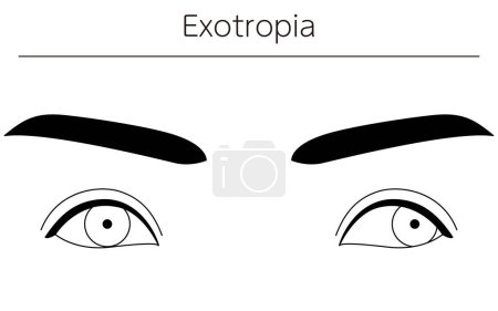 Illustration for Medical illustrations, diagrammatic line drawings of eye diseases, strabismus and exotropia, Vector Illustration - Royalty Free Image