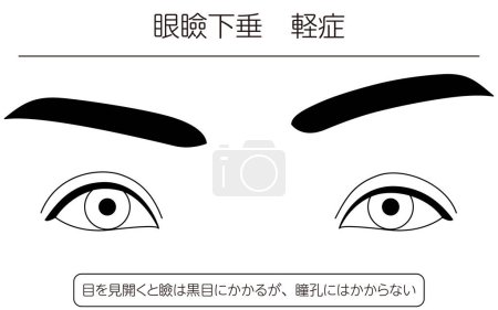 Illustration for Medical illustration: Diagram of mild ptosis (eyelid drooping) - Translation: When opening the eyes, the eyelid covers the iris but not the pupil. - Royalty Free Image