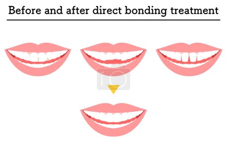 Ilustración de Odontología cosmética: tratamiento con unión directa, dientes descompuestos o astillados, y huecos, ilustración vectorial - Imagen libre de derechos